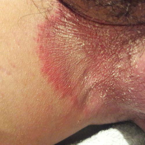 Tinea inguinalis