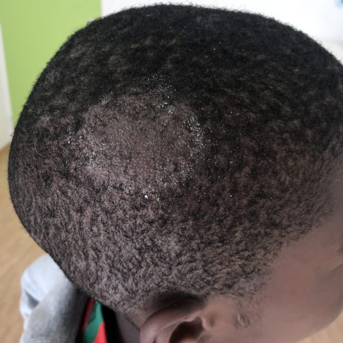 Tinea Capitis auf dunkler Haut bei einem Kind
