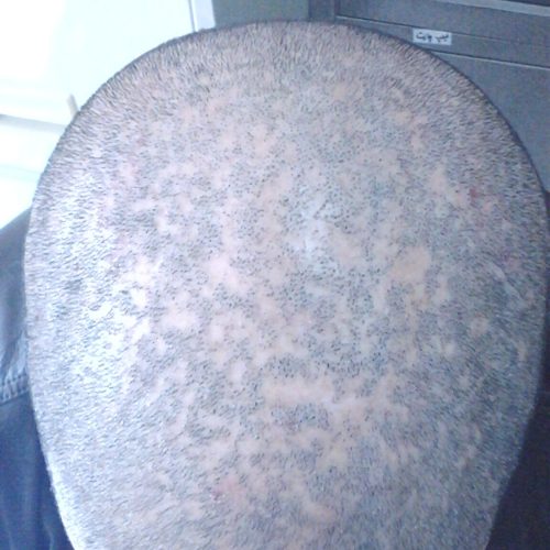 Tinea Capitis des gesamten Kopfes