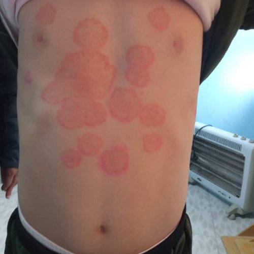 Landkartenähnliche Formationen bei Tinea corporis