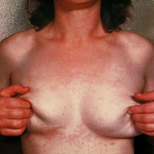 Plaques an Brust durch Malassezia Infektion.