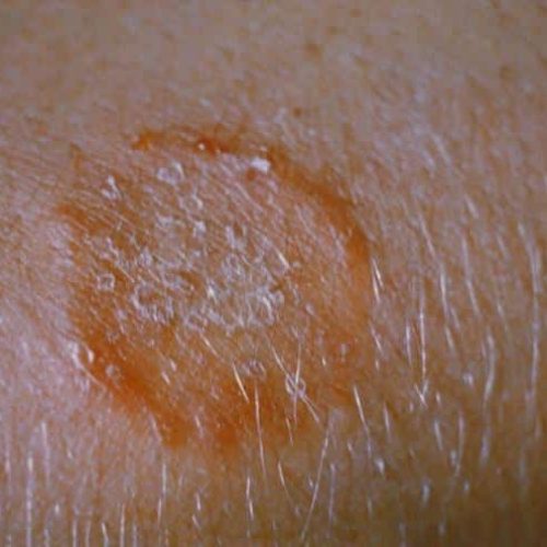 Typische Hautveränderung bei Ringelflechte