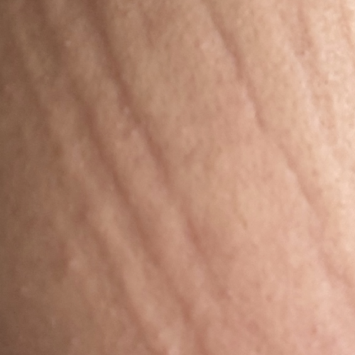 Nesselsucht factitia