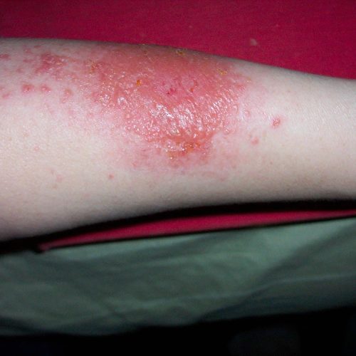 Nässende Kontaktdermatitis am Unterarm mit Blasenbildung.