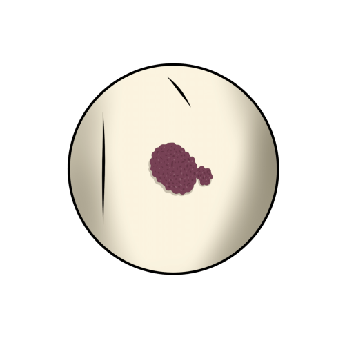 Seborrhoische Keratose (Verruca seborrhoica)