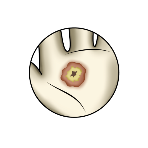 Dornwarzen (Verruca vulgaris)
