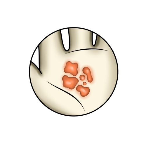 Flachwarzen (Verrucae planae juveniles)