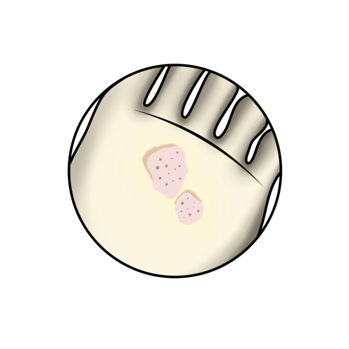 Plantarwarzen (Verrucae plantares)
