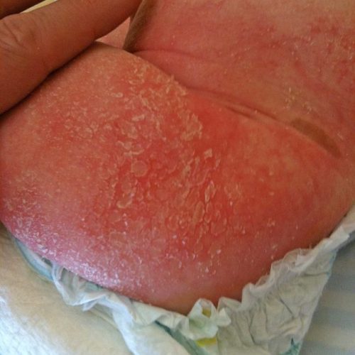 Windeldermatitis Schuppen