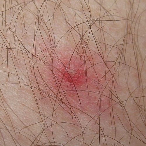 Zeckenbiss, nach Entfernung