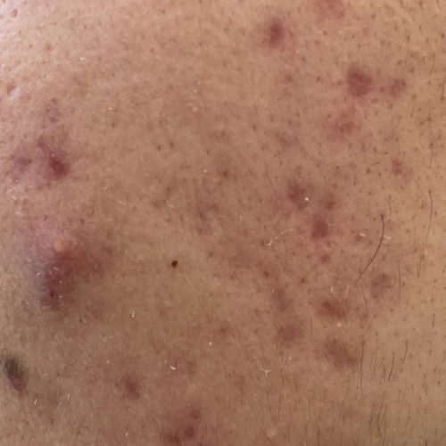 akne beim mann im gesicht