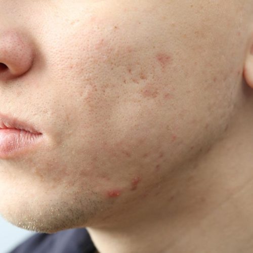 männergesicht mit akne