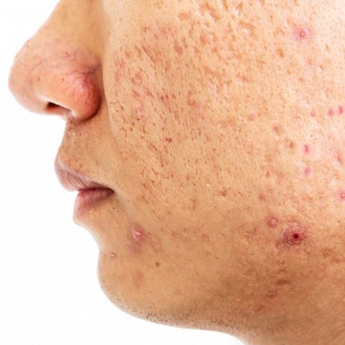 symptome bei akne im gesicht
