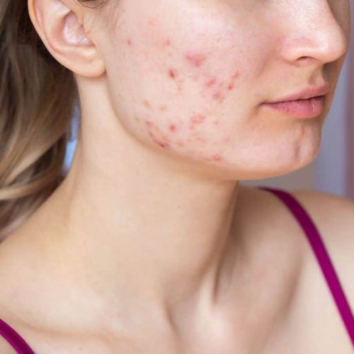akne im gesicht