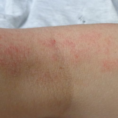 Neurodermitis in der Ellenbeuge