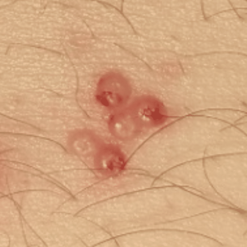 Dellwarzen auf der haut