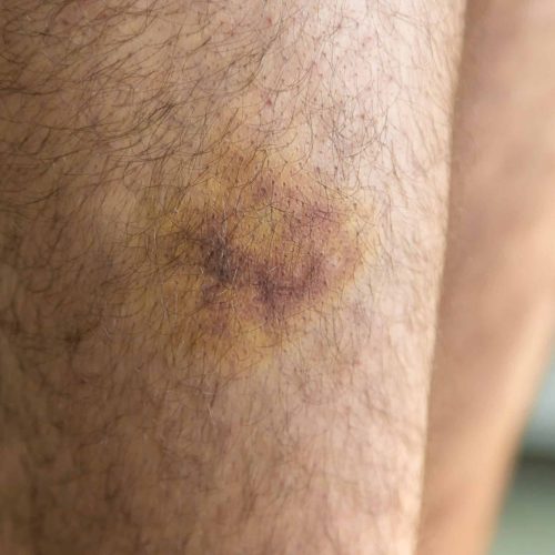 Bluterguss am Bein eines Mannes