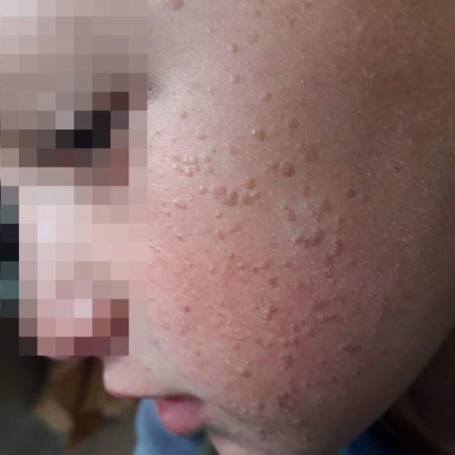 Flachwarzen im Kindergesicht