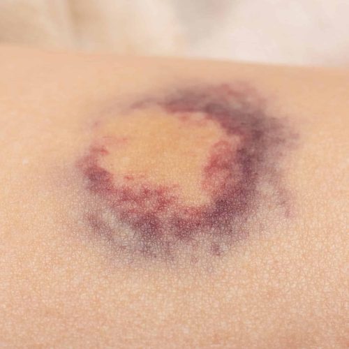 Hämatom nach Trauma