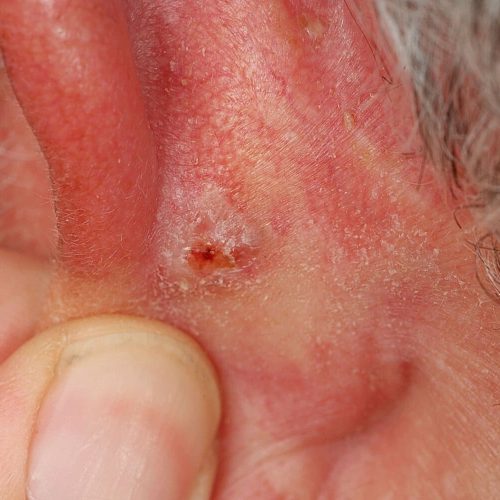 Basalzellkarzinom hinter dem linken Ohr