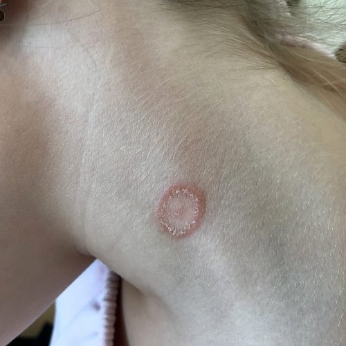 Ringelpilzflechte am Hals