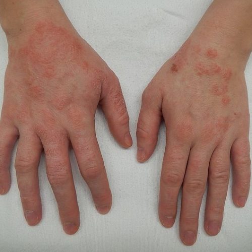 irritative Dermatitis Hand