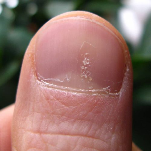 Leichte Tüpfelnägel