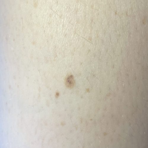 Muttermal von Hautarzt anschauen lassen