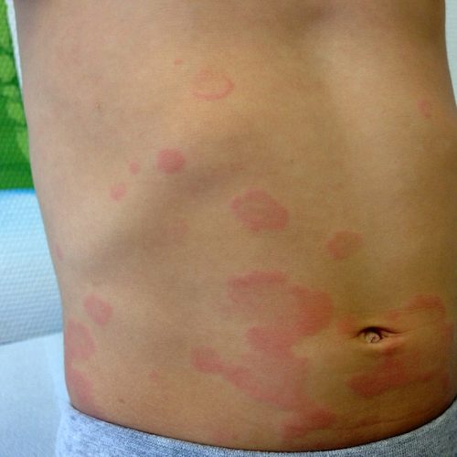 Urtikaria beim Kind