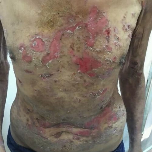 Pemphigus vulgaris am Oberkörper