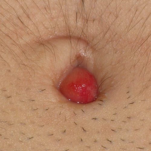 Pyogenes Granulom nach einer Bauchnabelentzündung