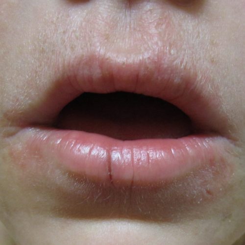 Männermund mit eingerissener Lippe und Dermatitis.