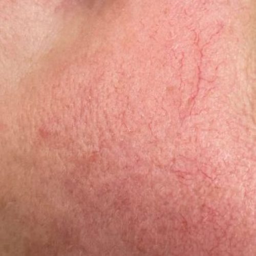 Rosazea im Frühstadium I (Couperose)