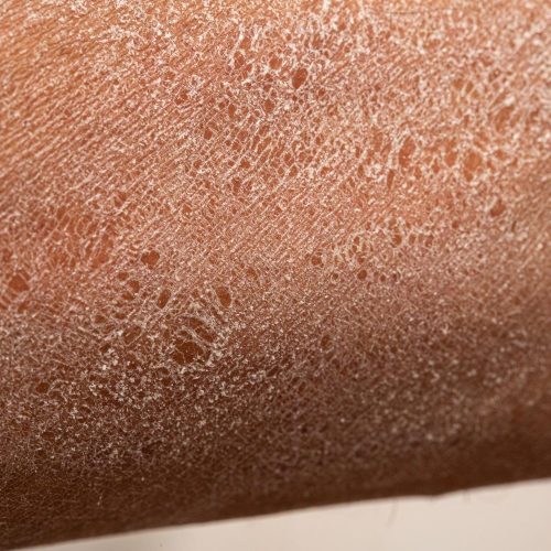 Trockene Haut an Armen