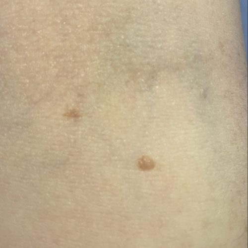 unbedenklicher leberfleck